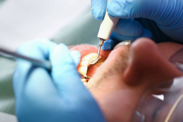 Best Emergency Treatment for Dental Infections or Abscesses in Collegeville, PA