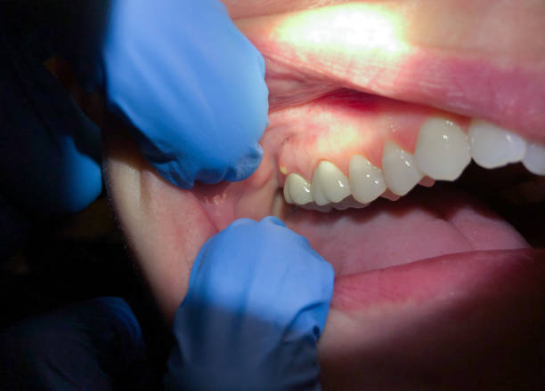 Best Emergency Gum Treatment in Collegeville, PA
